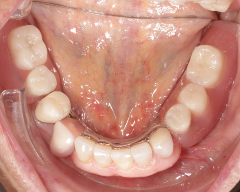 De frameprothese klikt op het systeem van de implantaten.